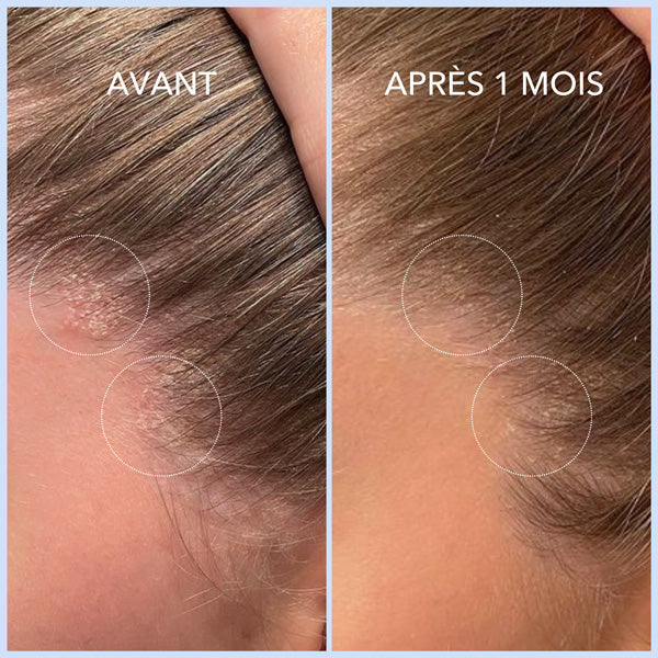 PSORIASIS